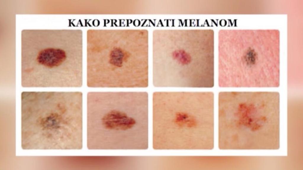 Maj mesec borbe protiv melanoma