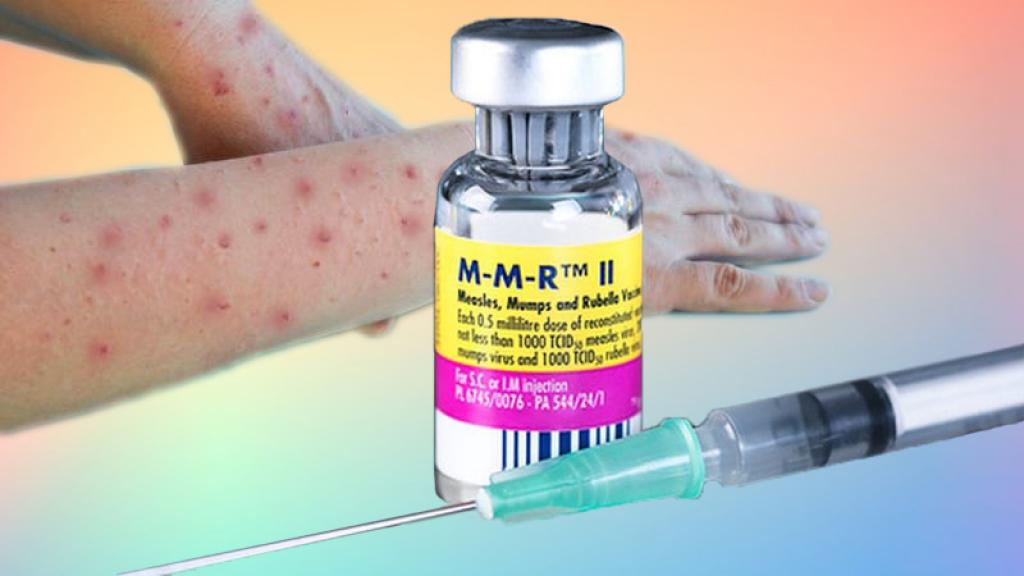 Registrovano 36 slučajeva morbila, vakcinacija najbolji efekat zaštite