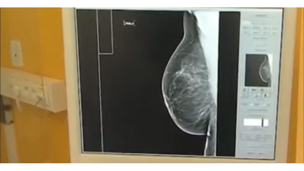 Uskoro savremeni digitalni mamograf: Više mladih žena odlučuje se na preventivne preglede