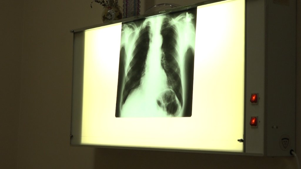 Tuberkoloza i dalje prisutna, situacija u SBO povoljna