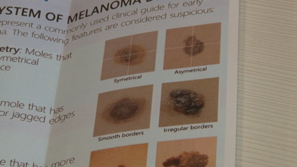  Samopregledi  ključni  u  borbi protiv melanoma 