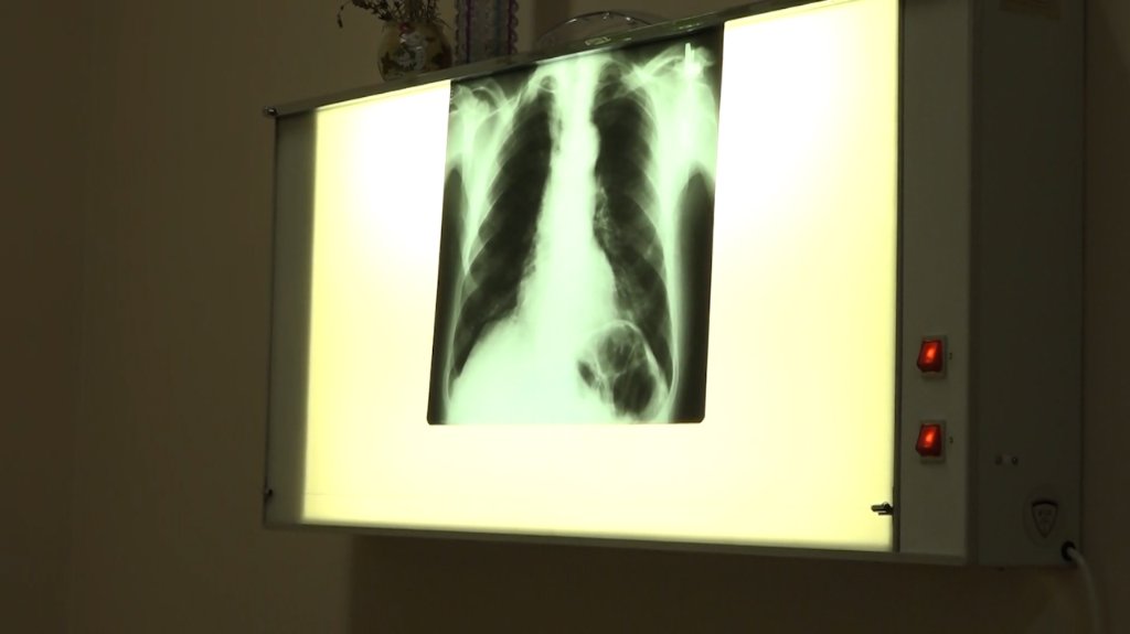 Tuberkuloza nije iskorenjena, pet aktivnih slučajeva 